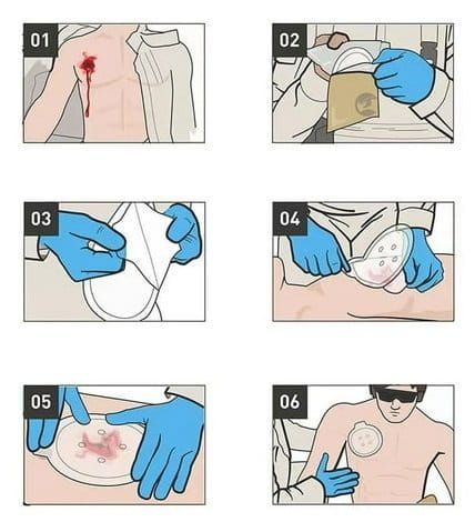 Opatrunek wentylowany okluzyjny - ACS